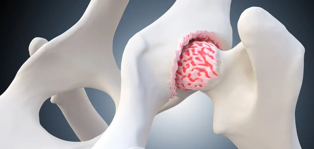 recuperare-după-proteză-de-șold