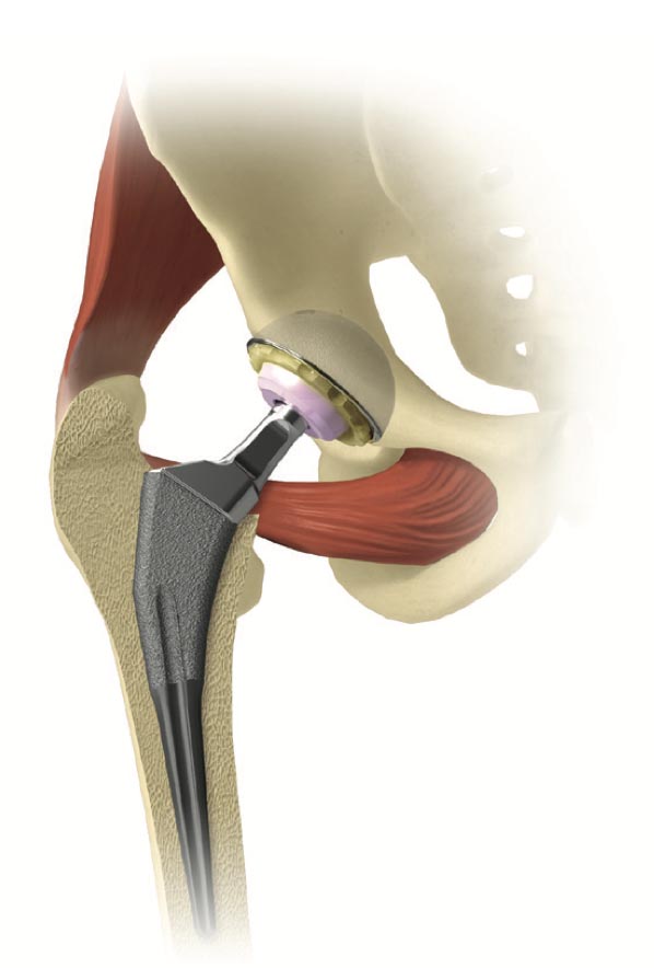 Endoprotezare sold Dr Razvan Lupescu timisoara